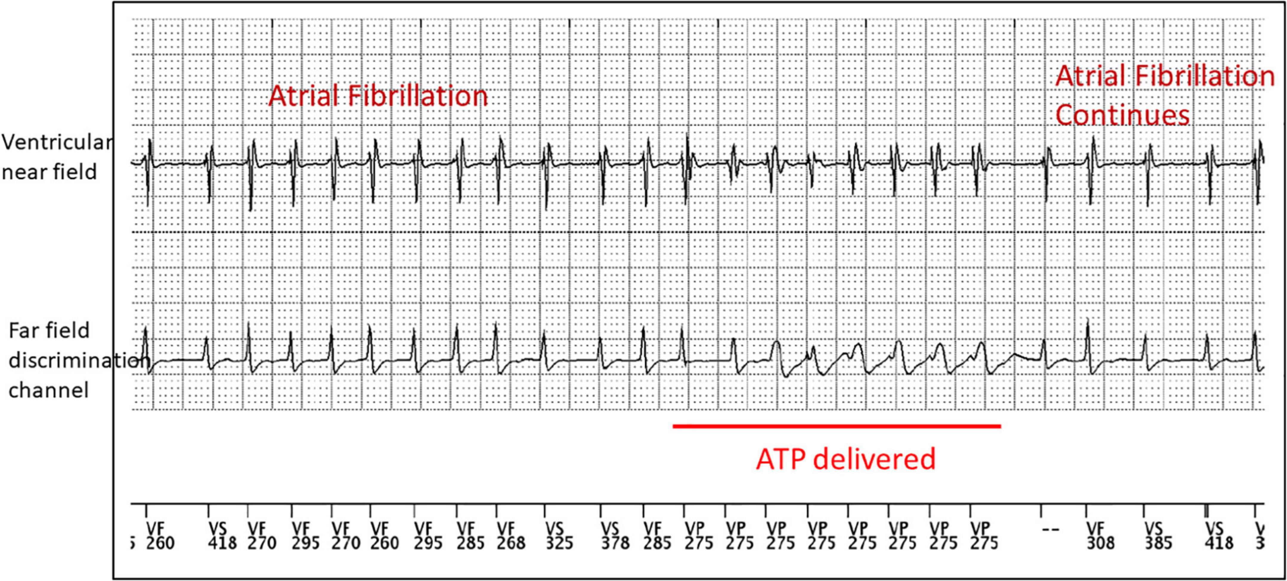 Frontiers Sex Rhythm And Death The Effect Of Sexual Activity On Cardiac Arrhythmias And Sudden