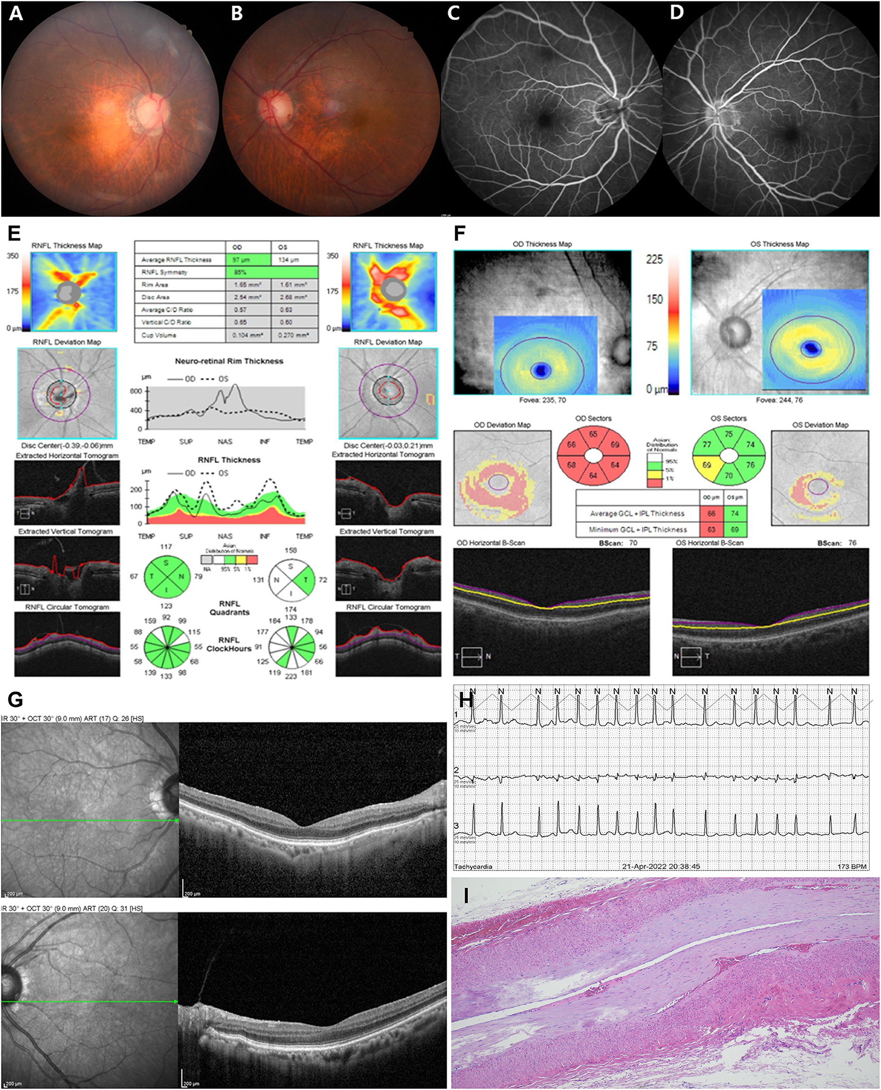 Ischemic Optic Neuropathies