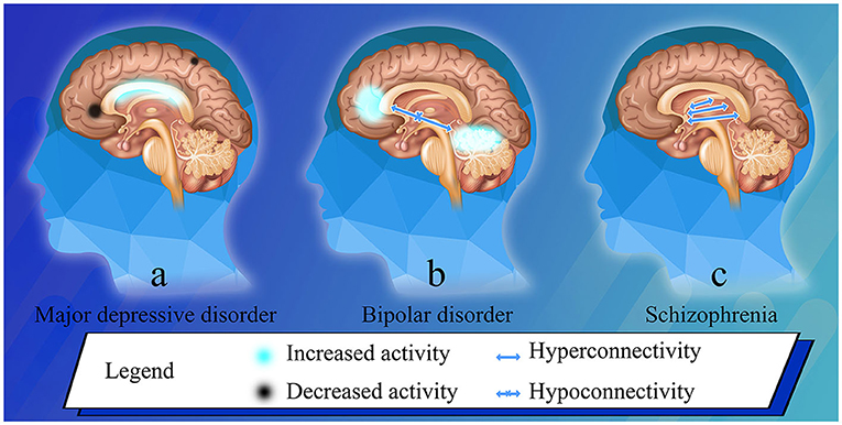 Frontiers  Neural activity in adults with major depressive disorder  differs from that in healthy individuals: A resting-state functional  magnetic resonance imaging study