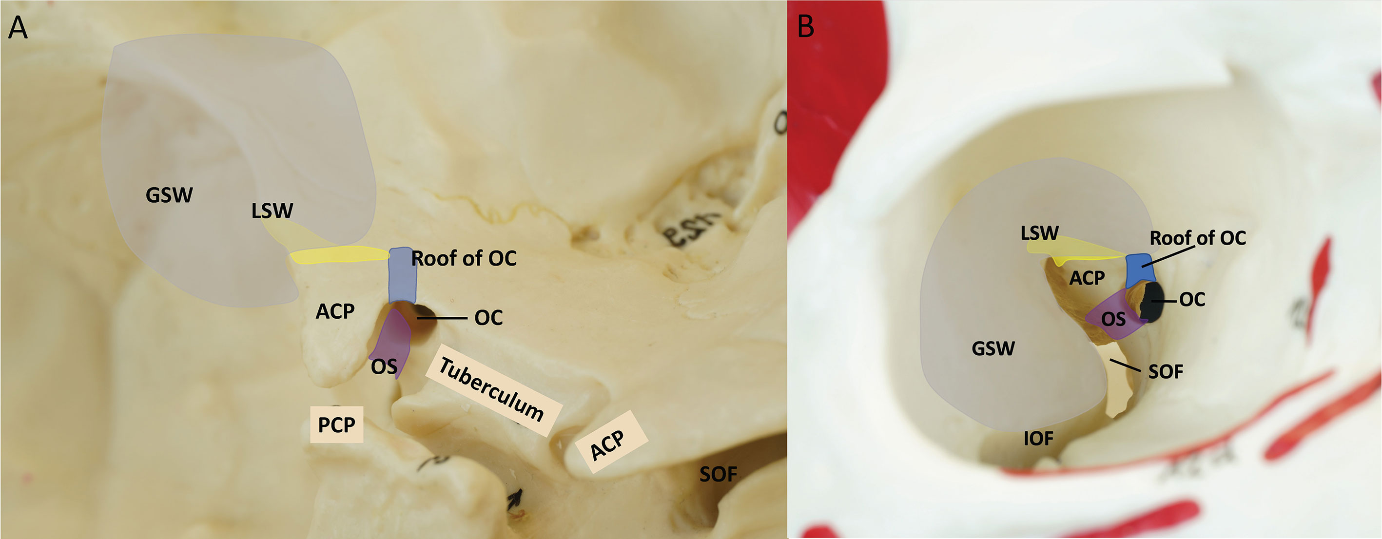 Frontiers | endoscopic transorbital extradural anterior clinoidectomy