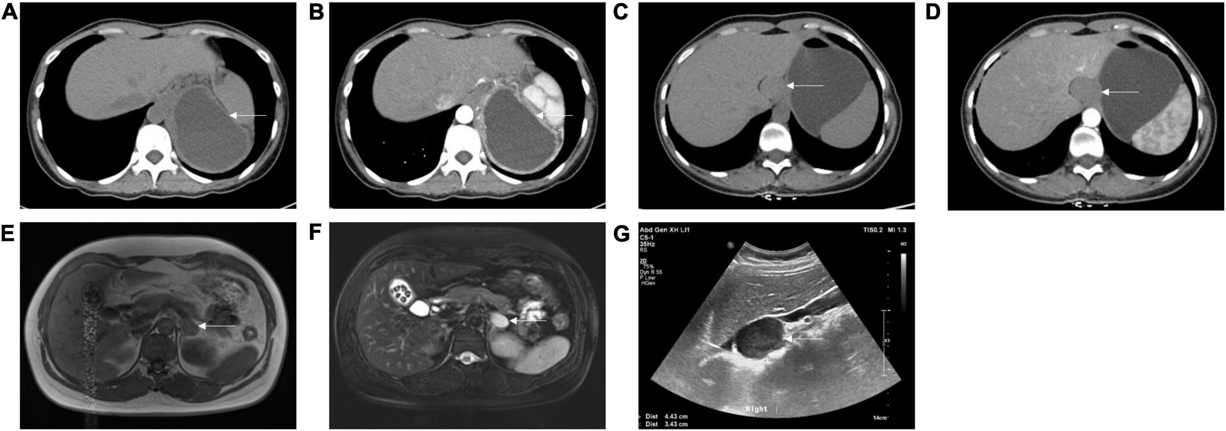 Frontiers | Subdiaphragmatic bronchogenic cysts: Case series and literature  review