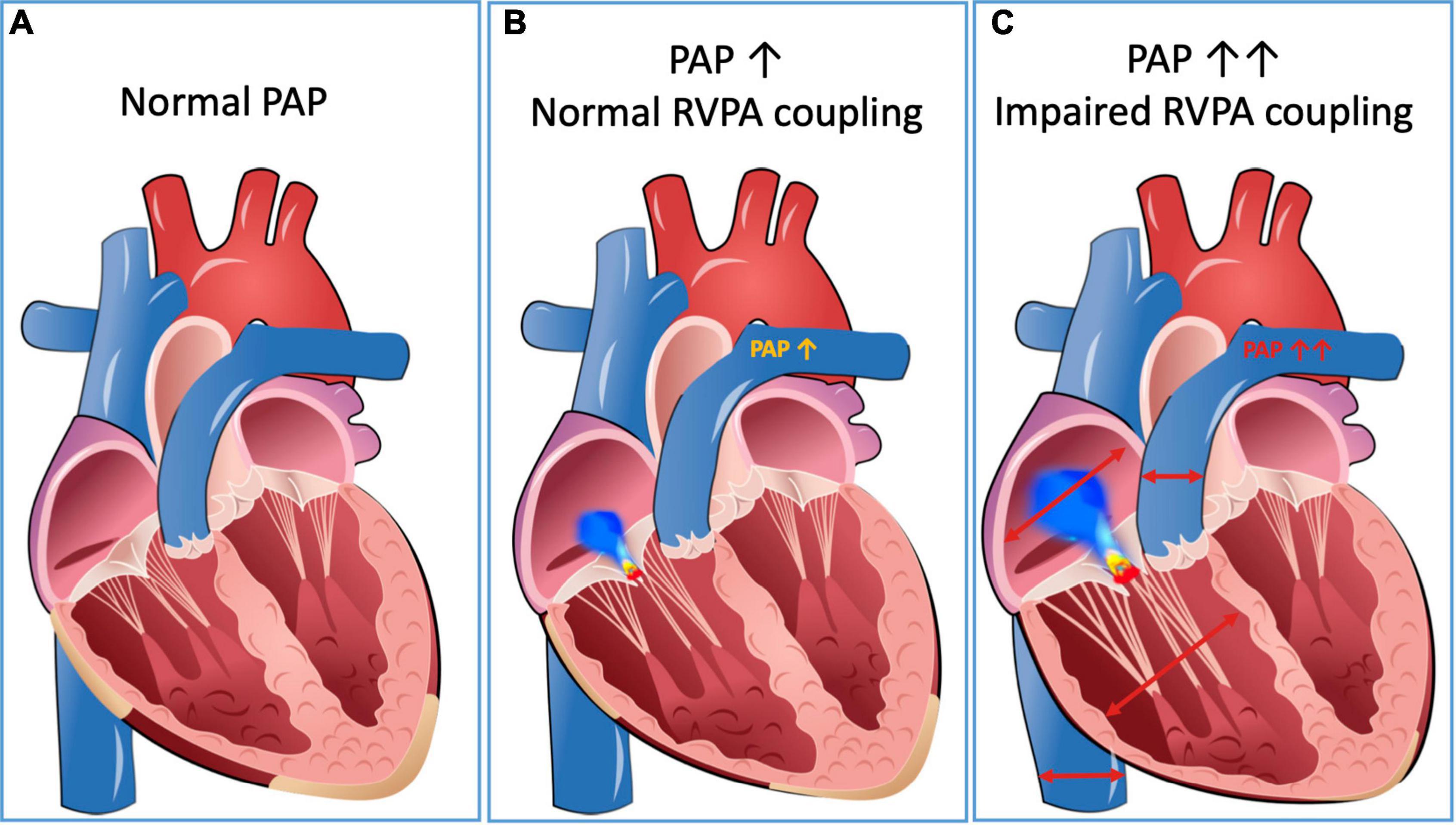 Transcatheter Edge to edge Repair TEER Of The Tricuspid 50 OFF