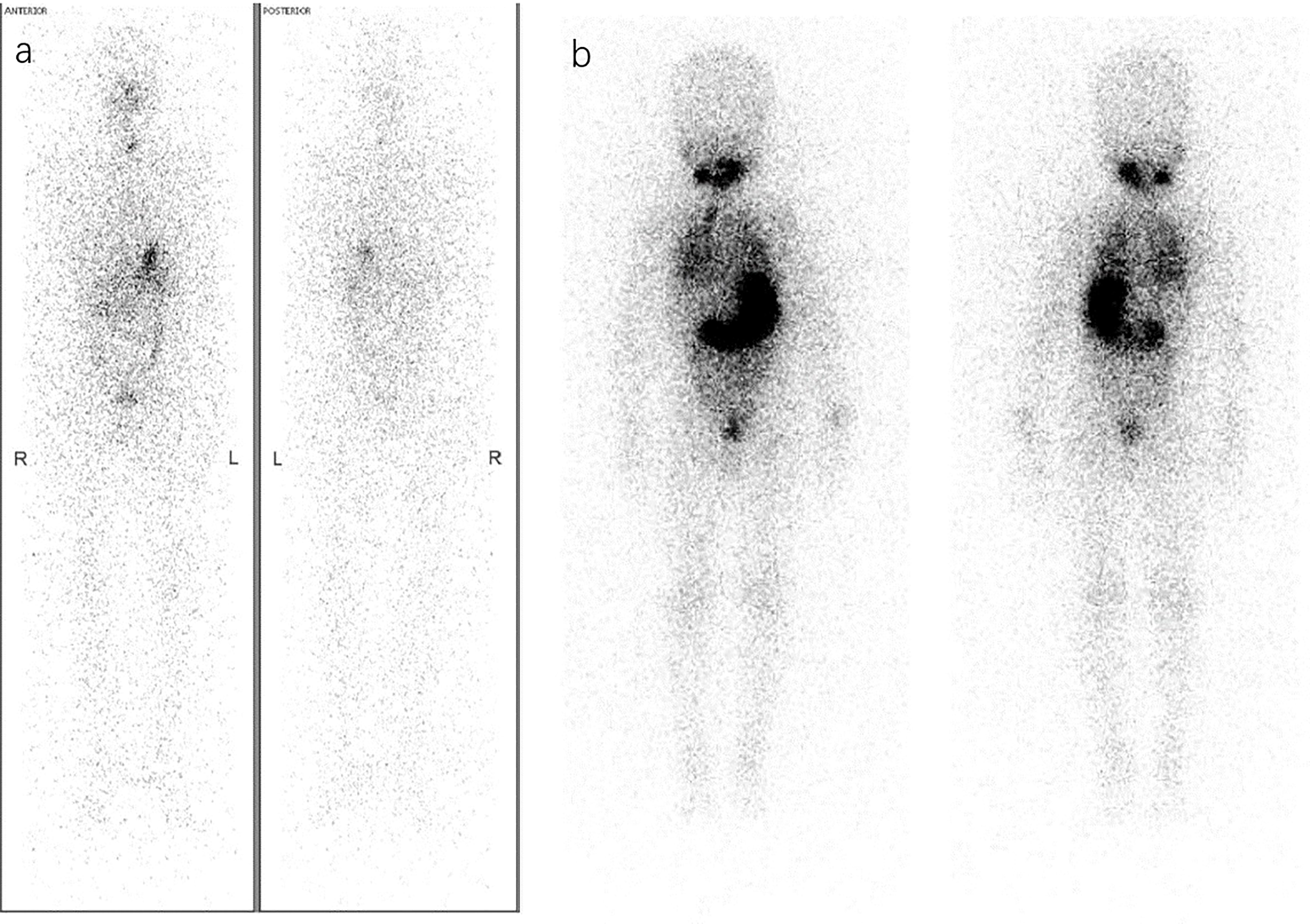 Frontiers Radioiodine adjuvant therapy in differentiated thyroid