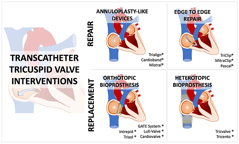 Frontiers Transcatheter Tricuspid Valve Interventions Current Status