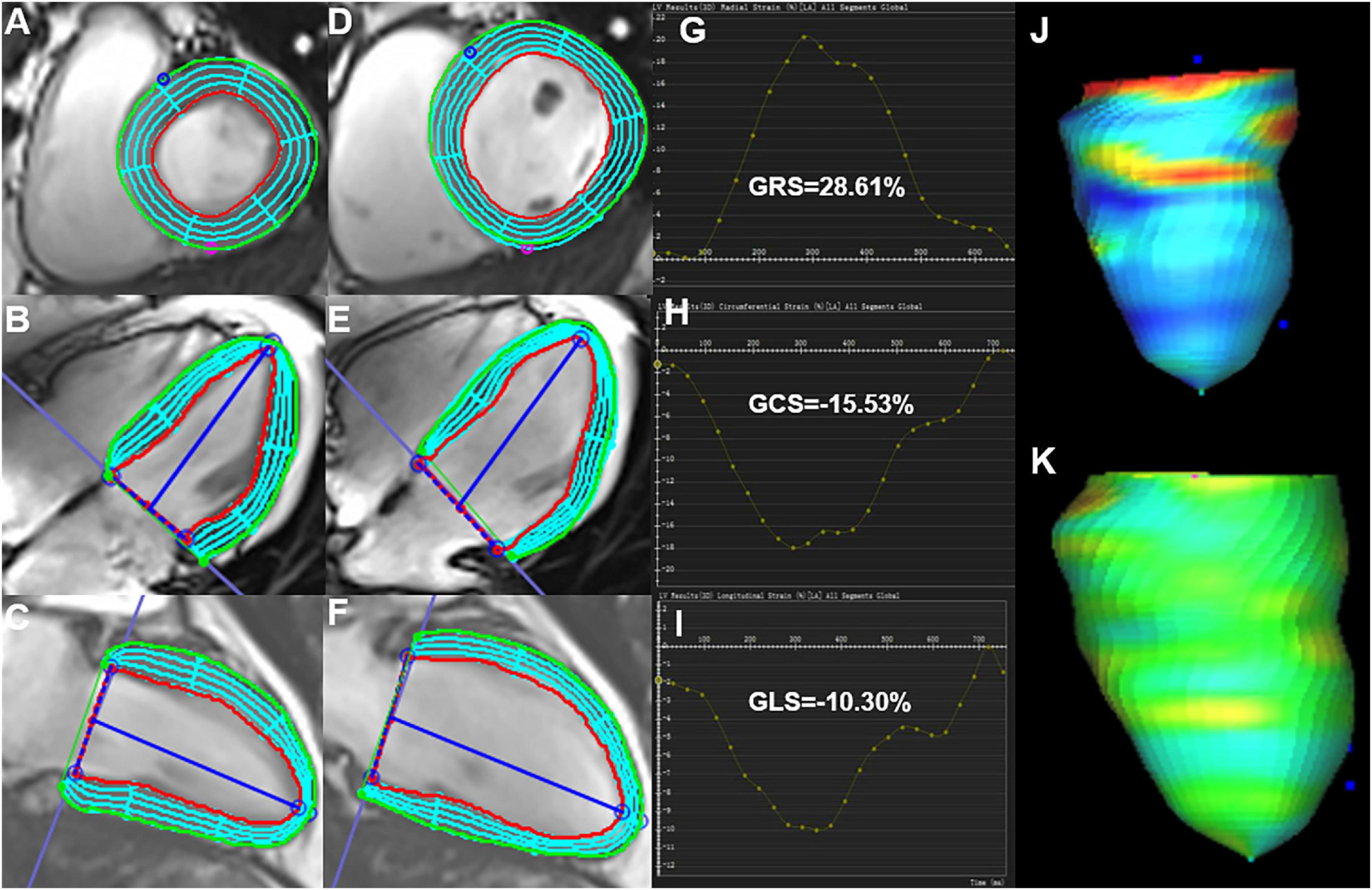 Feature Tracking of Global Longitudinal Strain by Using