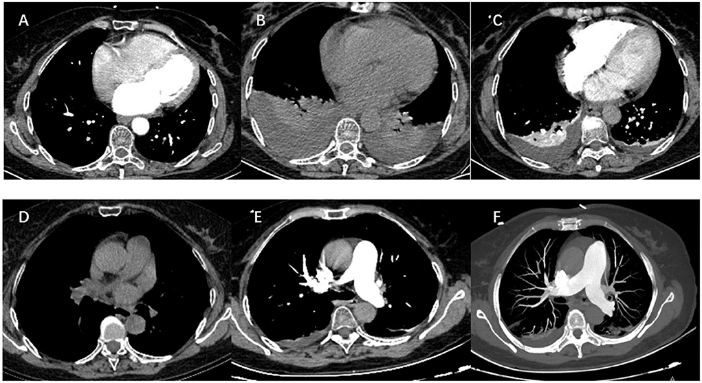 PDF) Conventional radiofrequency treatment in five patients with