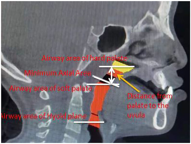 muscles of the soft palate lateral view