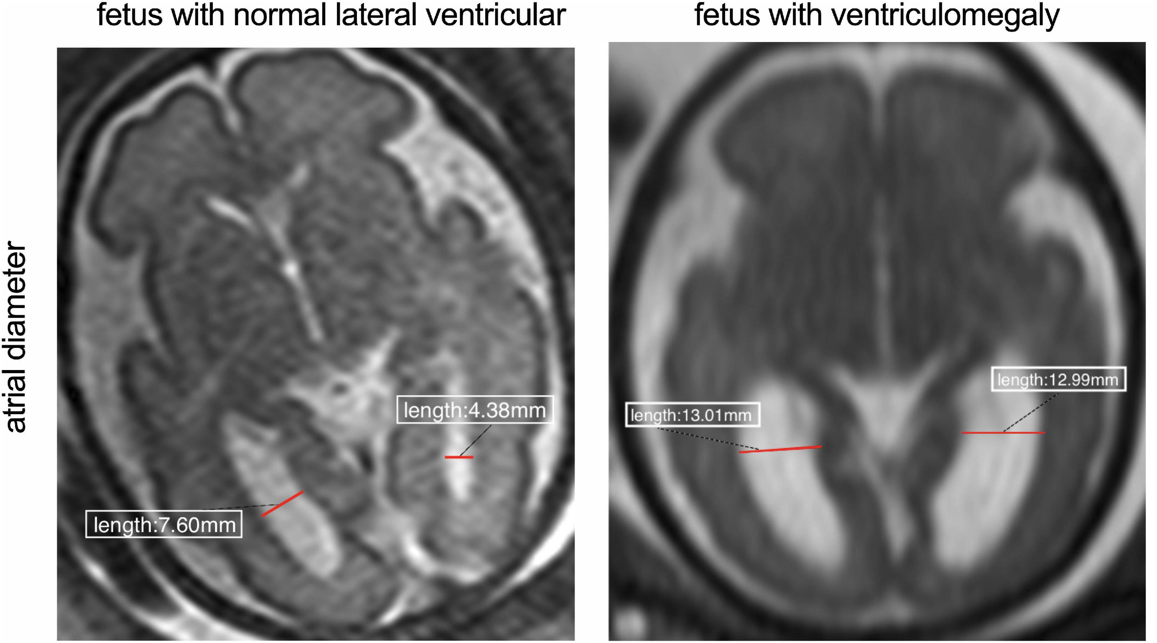 Frontiers  Maternal blood inflammatory marker levels increased in fetuses  with ventriculomegaly