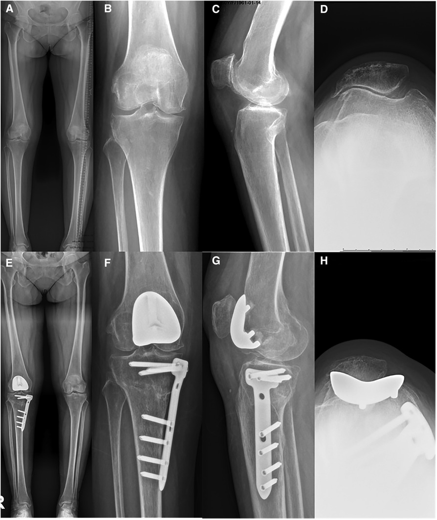Frontiers | Patellofemoral arthroplasty in combination with high tibial osteotomy can achieve good outcome for patients with medial-patellofemoral osteoarthritis Frontiers | Patellofemoral arthroplasty in combination with high tibial osteotomy can achieve good outcome for patients with medial-patellofemoral osteoarthritis