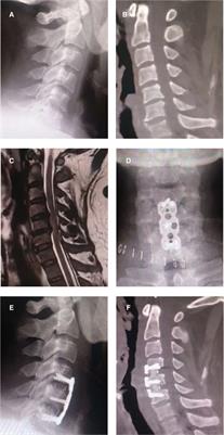 LATEST ADVANCES IN THE TREATMENT OF CERVICAL SPINE DEGENERATION