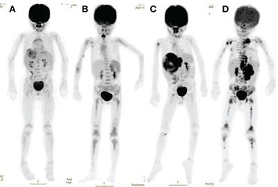 Frontiers | Comparing the diagnostic value of 18F-FDG PET/CT scan and ...