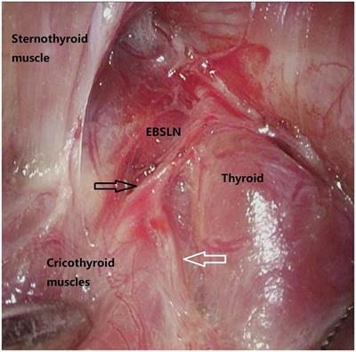 Surgical anatomy of the external branch of the superior laryngeal