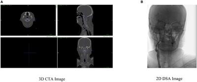 Frontiers | Enhancing the depth perception of DSA images with 2D–3D ...