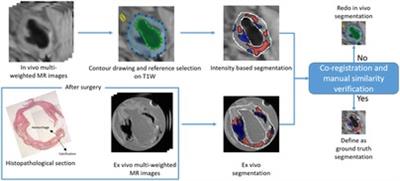 Frontiers  Characteristics and evaluation of atherosclerotic plaques: an  overview of state-of-the-art techniques