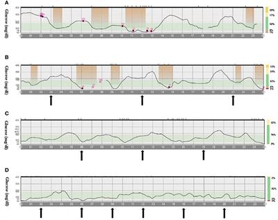 Frontiers  Case report: A 10-year prognosis of neonatal diabetes