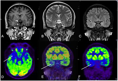 Frontiers | Utility of hybrid PET/MRI in stereoelectroencephalography ...