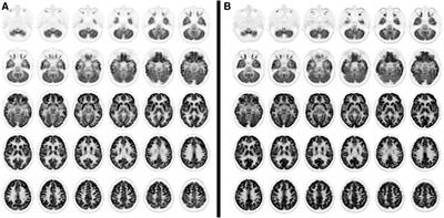 Background: Long Covid is increasingly recognized in adults and children, however it is still poorly characterized on a clinical and diagnostic perspe