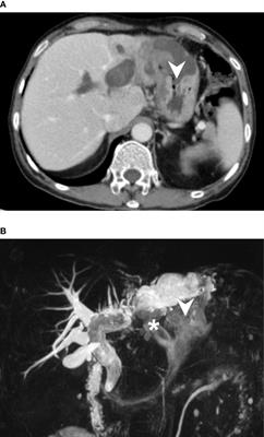 Intraductal papillary neoplasm of the bile duct presenting with  hepatogastric fistula: a case report and literature review - Frontiers