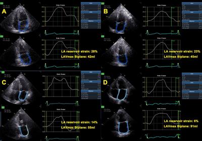 Normal Ranges of Left Atrial Strain by Speckle-Tracking Echocardiography: A  Systematic Review and Meta-Analysis - ScienceDirect