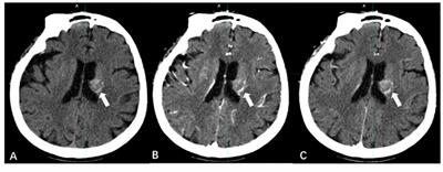 Advances in Determining the Gross Tumor Target Volume for Radiotherapy of Brain Metastases