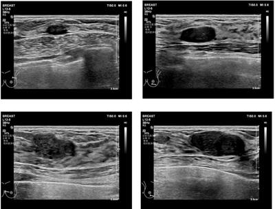 Frontiers | Case report: Fibroadenomas associated with atypical ductal ... image.