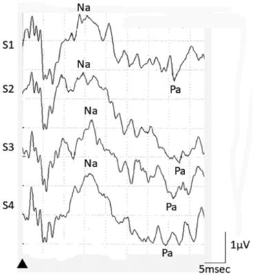 Frontiers | Habituation disorders in auditory middle latency response ...