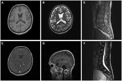 Streptococcus suis meningitis in China: a case report