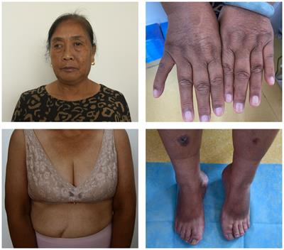 Hydroxychloroquine-induced hyperpigmentation of the skin and bull’s-eye maculopathy in rheumatic patients: a case report and literature review