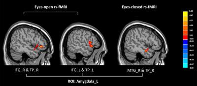 Frontiers | Aberrant Functional Connectivity between the Amygdala and the  Temporal Pole in Drug-Free Generalized Anxiety Disorder