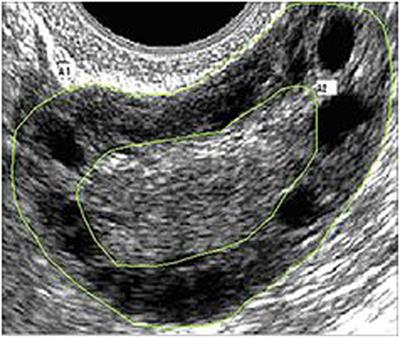 Frontiers | The Distribution of Stroma and Antral Follicles Differs between  Insulin-Resistance and Hyperandrogenism-Related Polycystic Ovarian Syndrome