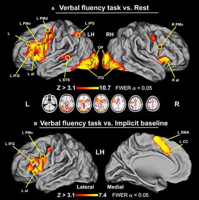 Frontiers Unique Neural Characteristics Of Atypical Lateralization Of Language In Healthy Individuals Neuroscience