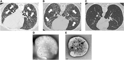 Frontiers The Immunome In Two Inherited Forms Of Pulmonary Fibrosis Immunology
