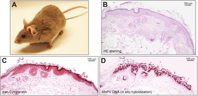 melanoma papilloma