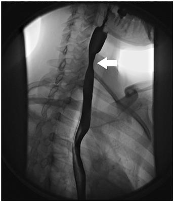 Eosinophilic oesophagitis: clinical presentation and pathogenesis – topic  of research paper in Clinical medicine. Download scholarly article PDF and  read for free on CyberLeninka open science hub.