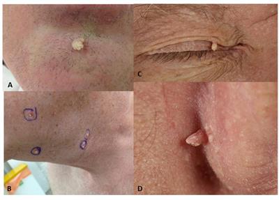 papillomatous lesions of skin