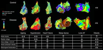 Frontiers Targeting The Substrate In Ablation Of Persistent Atrial Fibrillation Recent Lessons And Future Directions Physiology