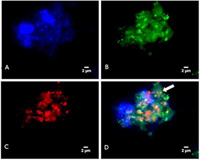Frontiers | Nine Cases of Methanogenic Archaea in Refractory Sinusitis, an  Emerging Clinical Entity