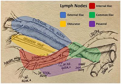 Frontiers The Role Of Lymph Node Dissection In The Treatment Of Bladder Cancer Surgery