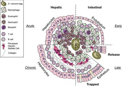 Schistosomiasis usmle - Schistosomiasis granuloma