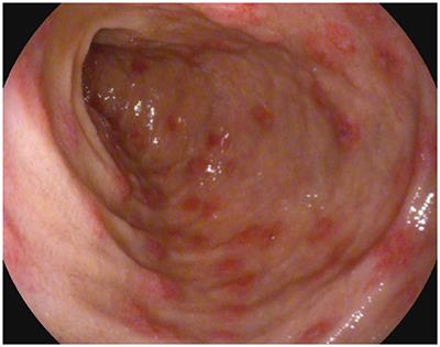 henoch schonlein purpura arthritis