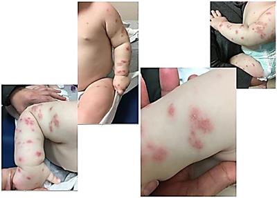 Frontiers Papulopustular Dermatitis In X Linked Chronic