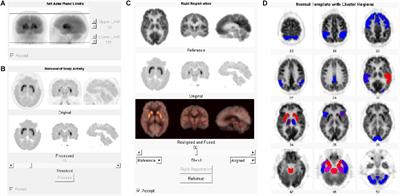 Frontiers | Quantitative Research of 11C-CFT and 18F-FDG PET in ...