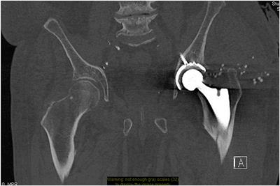 Frontiers | Radiological Imaging Evaluation Of The Failing Total Hip  Replacement