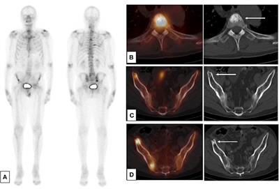 Frontiers | Imaging For Metastasis In Prostate Cancer: A Review Of The  Literature