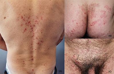Frontiers | Dermatitis Herpetiformis: Novel Perspectives