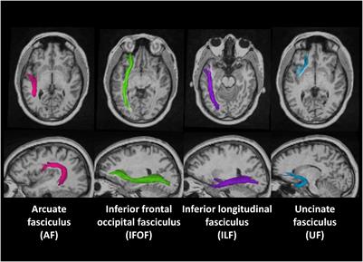 Effects of Early Language Deprivation on Brain Connectivity: Language Pathways in Deaf Native and Late First-Language Learners of American Sign Language