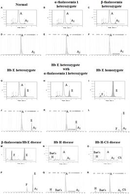 Frontiers Update In Laboratory Diagnosis Of Thalassemia Molecular Biosciences