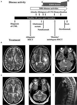 Frontiers A Case Of Multiple Sclerosis Like Relapsing Remitting Encephalomyelitis Following Allogeneic Hematopoietic Stem Cell Transplantation And A Review Of The Published Literature Immunology