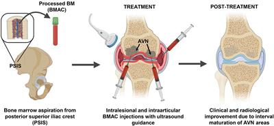 Frontiers | Intralesional Injection of Bone Marrow Aspirate Concentrate ...