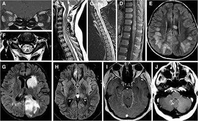 mog antibody disease mog antibody disease